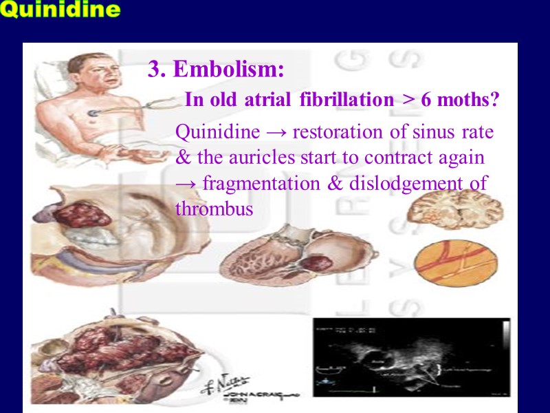 3. Embolism: In old atrial fibrillation > 6 moths?  Quinidine → restoration of